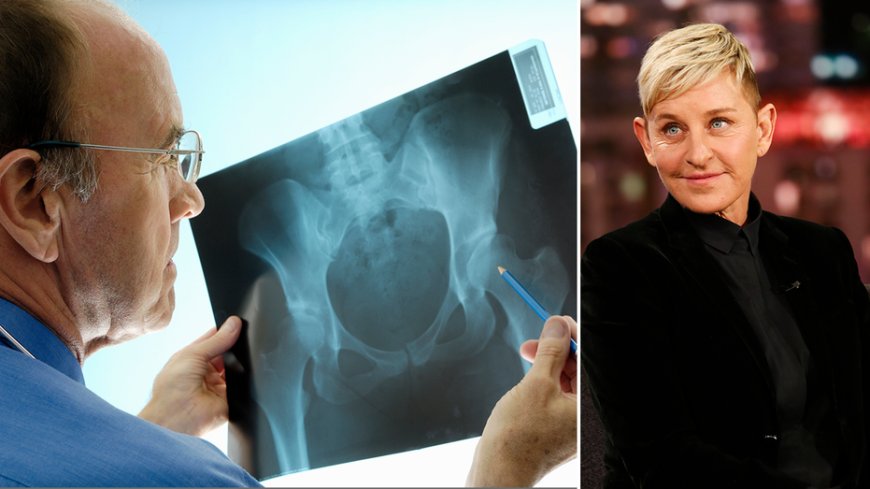 Ellen DeGeneres has osteoporosis: Here's what to know about the painful bone condition --[Reported by Umva mag]