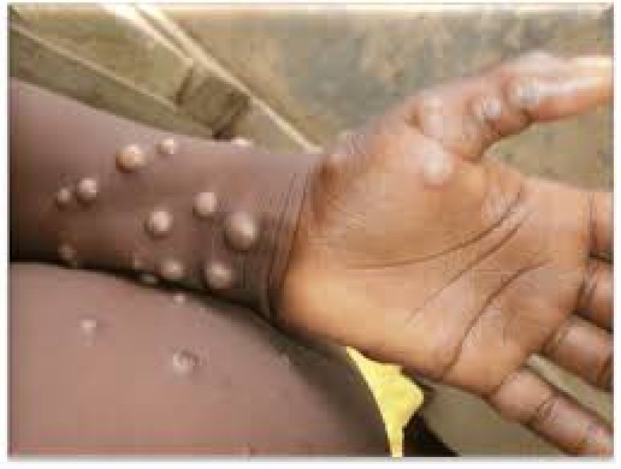 Ghana Health Service confirms first case of Mpox --[Reported by Umva mag]