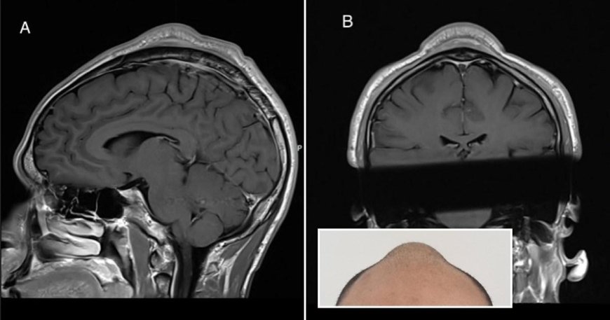 Man develops cone-shaped bulge on his head from breakdancing too much --[Reported by Umva mag]