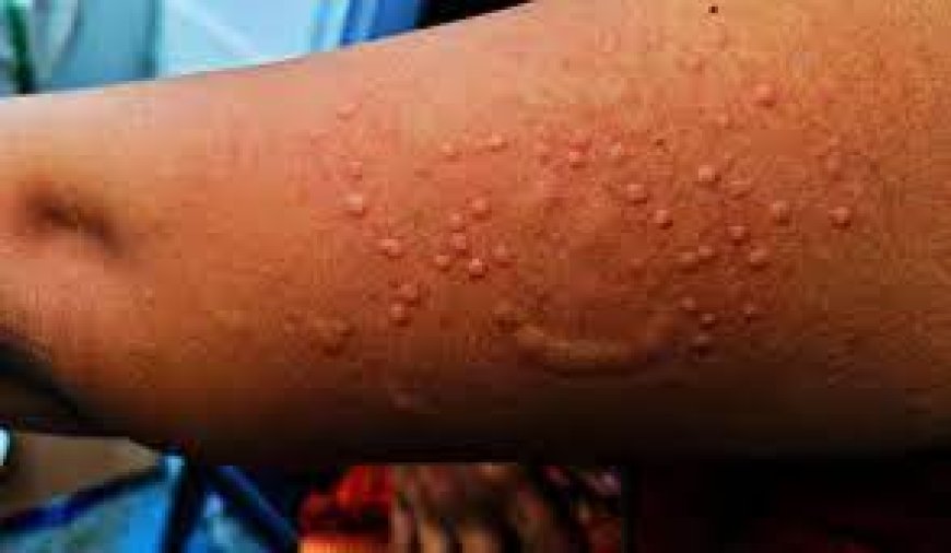 Africa mpox deaths at 979 as cases jump to 38,000 --[Reported by Umva mag]